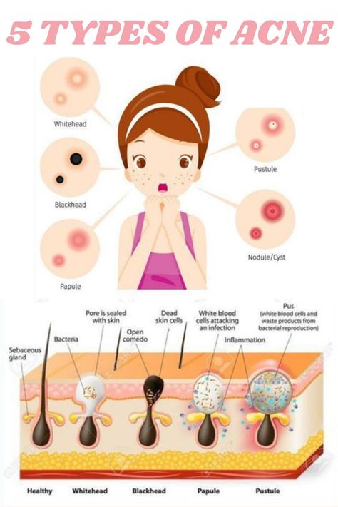 Papules Acne, Acne Pictures, Different Types Of Acne, Pimple Scars, Face Mapping, Types Of Acne, Acne Cream, Skin Repair, Facial Massage