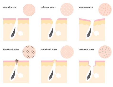 Although there is nothing you can do to actually decrease pore size, you can minimize their appearance. Here is how to minimize pores on your face for good. Skin Care Routine For Teens, Dusky Skin, Laser Skin Resurfacing, Nose Pores, Face Pores, Skin Care Routine For 20s, Reduce Pores, Laser Skin, Large Pores