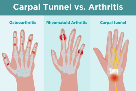 Arthritic Hand Pain Relief, Carpoltunal Relief Hands, Carpel Tunnel Symptoms, Carpultunal Wrist Relief, Arthritic Hands Natural Remedies, Carpal Tunnel Symptoms, Carpal Tunnel Remedies, Carpal Tunnel Exercises, Hand Problems