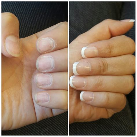 Before and after. Get lasting French tipped nails for about 3 weeks. Broadway press on nails. Real life in peach. Stop wasting money at the nail salon. French On Real Nails, French Tip On Real Nails, Press On French Tip Nails, Before And After Nails, Before After Nails, How To Get Fake Nails To Stay On Longer, French Manicure Real Nails, How To Do Deep French Nails, Broadway Nails