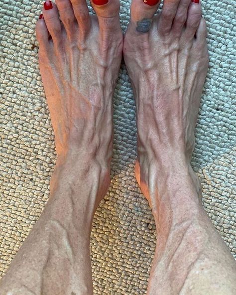 Mark on Instagram: “Beautiful and amazing vascular legs and feet shared by and thank you again so much to the amazing @whimsicalannie666 😘😘. Follow nicely for…” The Amazing, My Pictures, Thank You, On Instagram, Quick Saves, Instagram