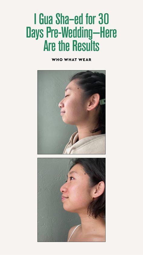 Gus Sha Before And After, Gua Sha Before And After, Gua Sha Massage, Gua Sha Facial, Gua Sha Tools, Acupuncture Points, Face Massage, Double Chin, Traditional Chinese Medicine