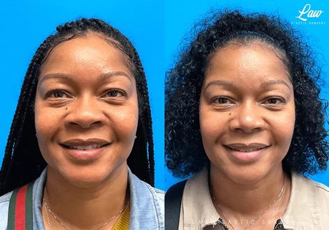 African American Rhinoplasty Before & After Photos - Law Plastic Surgery Rhinoplasty Before And After, Before After Photo, After Photos, Plastic Surgery, African American, Surgery