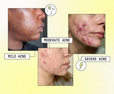 Acne Severities: How to Treat Mild, Moderate, and Severe Acne | Apostrophe Moderate Acne, Mild Acne, Acne Gel, Severe Acne, Acne Scar, Acne Scar Removal, Scar Removal, The Pack, To Read