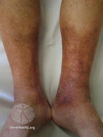 Leg Ulcers, Varicose Vein Remedy, Leg Veins, Venous Insufficiency, Foot Exercises, Poor Circulation, Skin Diseases, Health Facts, Health And Wellbeing