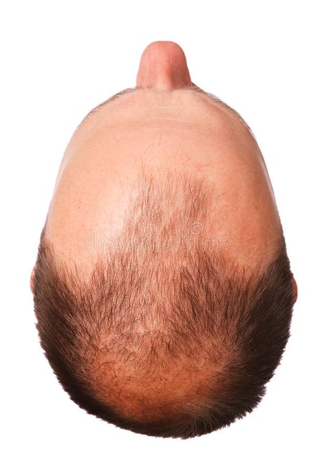 Male pattern baldness. Top of a man's head with male pattern baldness, isolated , #AFFILIATE, #Top, #man, #baldness, #Male, #pattern #ad Als Disease, Amyotrophic Lateral, Regrow Hair Naturally, Thick Hair Growth, Thick Hair Remedies, Lou Gehrig, Male Pattern Baldness, Hair Remedies For Growth, Pattern Baldness