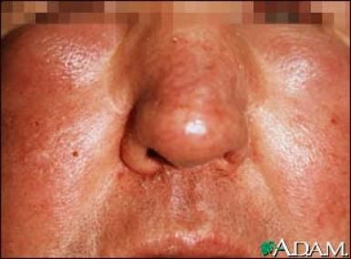 How Contact Dermatitis & Angioedema Are Different... Swelling Remedies, Facial Swelling, Sunburn Peeling, Natural Face Care, Jaw Surgery, Histamine Intolerance, Mount Sinai, Serious Skin Care, Perfect Skin Care Routine