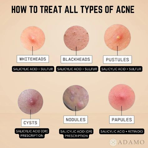 Beginner Skin Care Routine, Facial Routine Skincare, Medical Notes, Anklets Indian, Skin Facts, Skin Advice, Skin Aesthetics, Educate Yourself, Types Of Acne