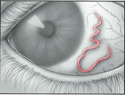 An illustration of a loa loa worm inside an eyeball which Claire sees for herself while in the Caribbean. Diana Gabaldon Books, Outlander Characters, Starz Tv Series, Diana Gabaldon Outlander Series, Lord John, Outlander Book Series, Diana Gabaldon Outlander, Medicine Chest, The Outlander