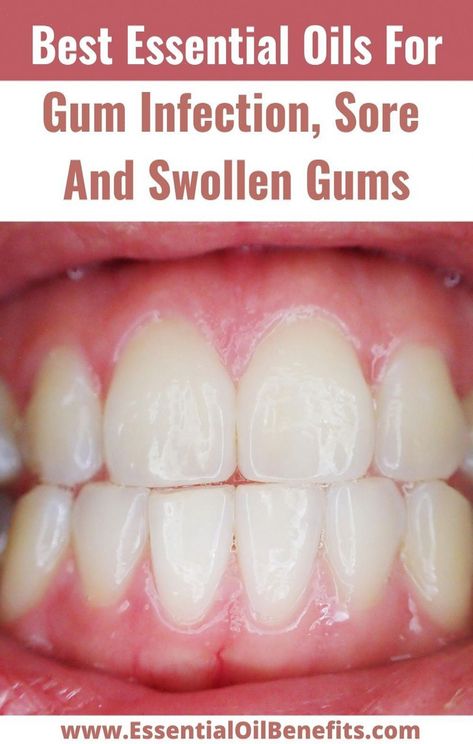 Best Essential Oils For Gum Infection, Sore And Swollen Gums #Gums #GumInfection #SwollenGum #EssentialOils #EssentialOilsUses #NaturalHealing #HomeRemedies #How #Regrowth #Wellness #SelfCare #to #Naturally #Tips #Receding #FitLife #Stimulate #Gums #for #HealthyLifestyle #Gum Healthy Liver Diet, Swollen Gum, Liver Diet, Natural Antibiotics, Oral Care Routine, Receding Gums, Essential Oil Benefits, Gum Health, Healthy Liver