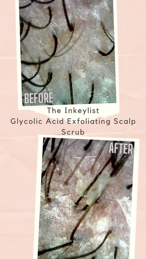 Scalp Exfoliator, Exfoliating Scalp, Exfoliate Scalp, Inkey List, Under A Microscope, Scalp Scrub, Hair Spa, Exfoliating Scrub, Benzoic Acid