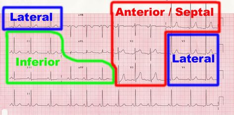 ecg-zones Ekg Leads, St Elevation, Nerdy Nurse, Cardiology Nursing, Ekg Interpretation, Medical Assisting, Ecg Interpretation, Paramedic School, Student Info