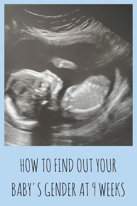 How to find out your baby’s gender at 9 weeks Baby Heartbeat Gender Prediction, Heartbeat Gender Prediction, Baby Heart Rate Gender, Ultrasound Boy Or Girl, 10 Weeks Pregnant Ultrasound, 9 Weeks Pregnant Ultrasound, Boy Vs Girl Pregnancy, Baby Gender Ultrasound, Baby At 10 Weeks