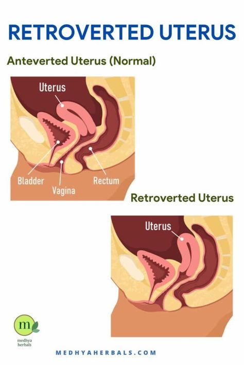 <p>An anteverted uterus, though it may sound complex, holds the key to understanding your reproductive health. If you’ve ever wondered, “Is an anteverted uterus good or bad?” or pondered the mysteries behind “anteverted uterus pregnancy bumps,” you’re in the right place. In this blog, we’ll decode the significance of an anteverted uterus, its potential impact […]</p> <p>The post <a rel="nofollow" href="https://medhyaherbals.com/anteverted-uterus... Polyps Uterus Remedies, Polyps Uterus, Tilted Uterus, Uterus Health, Retroverted Uterus, Bicornuate Uterus, Prolapsed Uterus, Pregnancy Chart, Pelvic Girdle