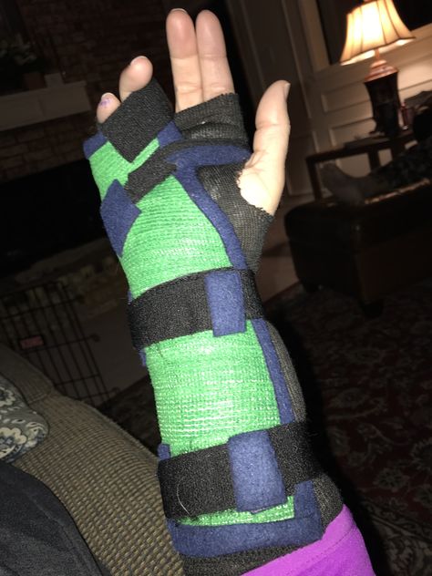 Removable cast. Why don’t all doctors use functional casting? Fracture Snap, Hand Fracture Snap, Cast Designs Arm, Cast On Arm Aesthetic, Arm Cast Aesthetic, Full Body Cast Hospital, Wrist Cast, Broken Arm Cast, Hand Fracture