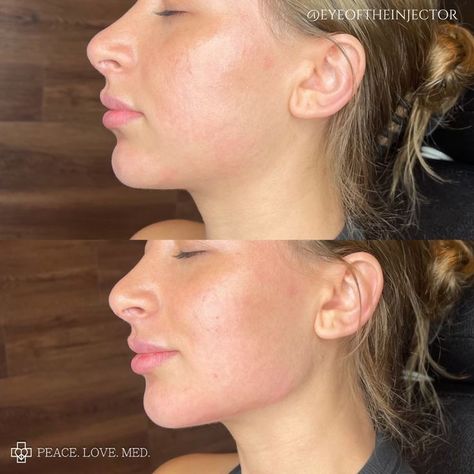 Cheek And Jaw Fillers, Jaw Line Botox Before And After, Jaw And Chin Filler Before And After, Before And After Jaw Filler, Botox For Slimmer Face, Jaw Contouring Filler, Jawline Contouring Filler, Facial Symmetry Filler, Facial Balancing Filler Before And After