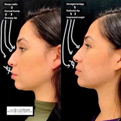 Liquid Rhinoplasty, Nonsurgical Nose Job, Nose Fillers, Facial Procedure, Rhinoplasty Nose Jobs, Anti Aging Skin Care Diy, Rhinoplasty Before And After, Injectables Fillers, Reconstructive Surgery