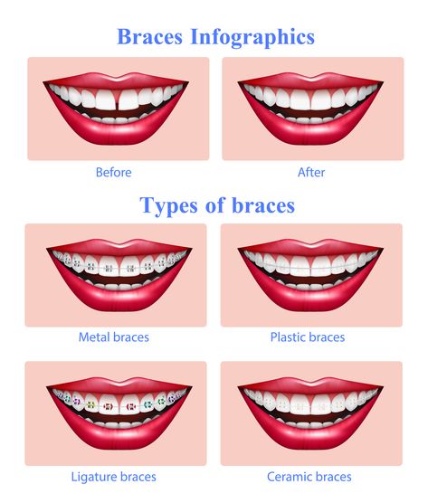 Braces Infographics Braces Types, Red Glossy Lips, Opened Mouth, Ceramic Braces, Braces Cost, Types Of Braces, Teeth Alignment, Dental Braces, Orthodontics Braces