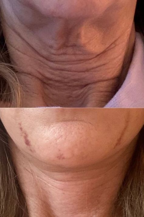 Say goodbye to neck wrinkles! Explore effective treatments and unlock the secrets to a smoother, youthful-looking neck. Creamed Turkey, Turkey Neck, Neck Wrinkles, Neck Cream, Beauty Images, Say Goodbye, Beauty Inspiration, Wrinkles, Pure Products