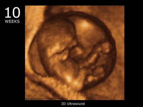 10 Weeks Pregnant Ultrasound, Baby At 10 Weeks, 10 Week Ultrasound, 16 Weeks Pregnant Belly, 16 Weeks Pregnant Ultrasound, Pregnant Ultrasound, 10 Weeks Pregnant, 3d Ultrasound, 4d Ultrasound