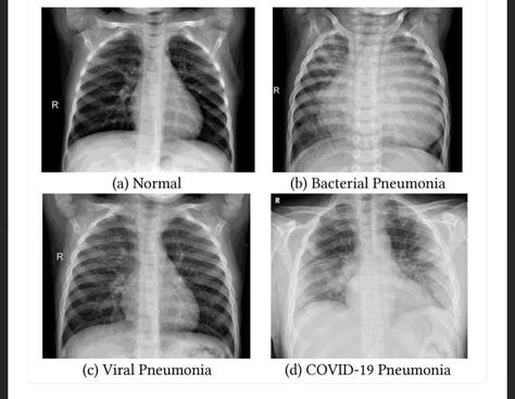 Chest Xray Pneumonia, Diagnostic Radiography, Remedies For Bronchitis, Chest Xray, Medical Radiography, Nurse Practioner, Home Remedies For Bronchitis, Radiology Student, Radiology Imaging