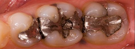 Cavity preparation of amalgam restoratios Prepared by : Maha Akram ￼ HISTORY ◦ •Amalgam was introduced to the United States in the1830s. ◦ •Initially, amalgam restorations were made by dentists filing silver coins and mixing the filings with mercury, creating a putty-like mass that was placed into the defective tooth. ◦ As knowledge increased and research intensified, major advancements in the formulation and use of amalgam occurred. ◦ • However, concerns about mercury toxicity we Amalgam Fillings, Cavity Filling, Tooth Filling, Dental Fillings, American Dental Association, Flora Intestinal, Dental Practice, Tooth Decay, Autoimmune Disease