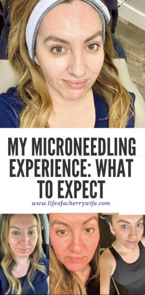 Microneedle Before And After, Skin Needling Before And After, Post Microneedling Care, What Is Microneedling, Microchanneling Before And After, Before And After Microneedling, Microneedling After Care Instructions, Microneedling Before And After At Home, Dr Pen Microneedling Before And After