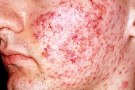 Dermatological Effects of Different Keratolytic Agents on Acne Vulgaris.@ http://www.omicsgroup.org/journals/dermatological-effects-of-different-keratolytic-agents-on-acne-vulgaris-2167-0870-1000262.php?aid=71859 Homemade Acne Mask, Proper Skin Care Routine, How To Reduce Pimples, Acne Mask, Acne Vulgaris, Face Care Routine, Rid Of Acne, Cystic Acne, Laser Therapy