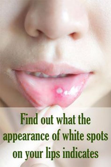 7 Best Tips to treat White Spots on Lips Blister On Lip, Sore Lips, Health Articles Wellness, Medical Terminology, Unwanted Hair Removal, Health Logo, Good Health Tips, Natural Health Remedies, Health Articles