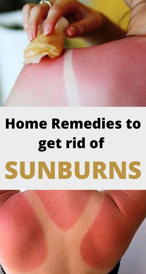 Home Remedies and Treatments to get rid of Sunburns fast Bad Sunburn Remedies, Diy Sunburn Remedies, Quick Sunburn Remedies, How To Get Rid Of A Sunburn Fast, Sun Burn Remedy, Healing Sunburns Overnight, What Helps With Sunburns, Sunburn On Face, How To Heal Sunburn Fast