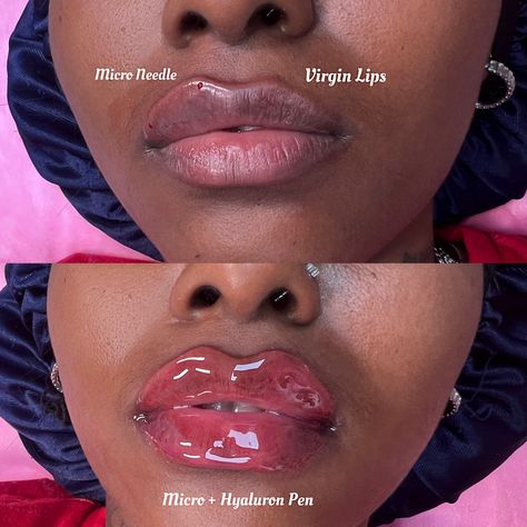 Perfect lips do exist 🥹 Micro needle just makes lips look so perfect and perfectly pronounced! The goal is to have plump juicy lips😍 This noninvasive procedure will leave be your lips looking nice & full! Checklist: ✔️Enhancing Your Natural Lip Shape ✔️ 25-30 Minute Procedure ✔️ Numbing = so no pain Or discomfort ✔️ Fast Healing Process / Minimal To Zero Bruising ✔️ Multi Sessions Required To Obtain certain Desired Looks 1:1 Trainings Are Available, Dm me for ALL Inquiries on questions ... Desired Lips, Plump Lips Naturally, Micro Needle, Plump Lips, Lip Filler, Lip Shapes, Juicy Lips, Perfect Lips, Natural Lip