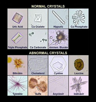 Medical Laboratory and Biomedical Science: Chrystals in Urine Laboratory Humor, Medical Lab Technician, Vet Tech School, Veterinary Tech, Medical Laboratory Technician, Microbiology Lab, Medical Laboratory Scientist, Clinical Chemistry, Technology Lab