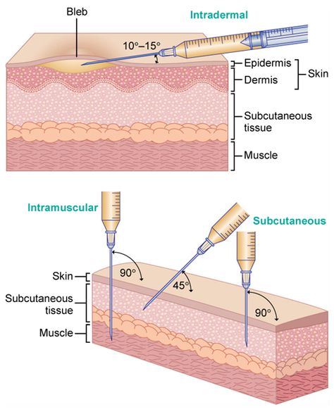 Needle Angles: Standard medication doses for adults are to be rounded to the nearest tenth (0.1) of a milliliter. The standard 3-mL syringe is calibrated in tenths of a milliliter. The nurse should not administer more than 3 mL per intramuscular or subcutaneous injection site; when a volume greater than 3 mL is required, a 5-mL syringe, calibrated in fifths, may be used. Medical Assisting, Certified Medical Assistant, Fundamentals Of Nursing, Nursing School Studying, Nursing School Tips, Nursing School Notes, Phlebotomy, Nursing Tips, Nursing Career