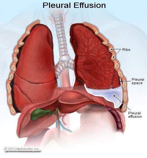 pleural effusion -- A collection of fluid between the lung and chest wall that may compress the lung. Most commonly, a pleural effusion is an incidental finding in a stable patient. Prehospital interventions are generally limited to patients who are in respiratory distress or are hemodynamically unstable.  As with any other life-threatening condition, initial management is directed at ensuring adequate oxygenation and ventilation. Oxygen should be administered to all unstable patients. Sistem Saraf, Pleural Effusion, Pulmonology, Respiratory Care, Respiratory Therapy, Respiratory Therapist, Nursing Tips, Nursing Notes, Nursing Education