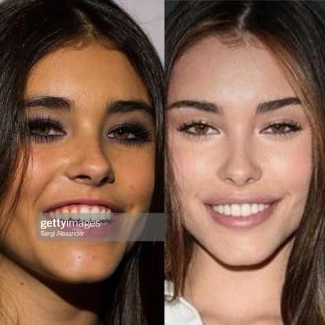 Madison Beer plastic surgery before and after Angelina Jolie Lip Filler, Madison Beer Lip Fillers, Madison Beer Lips, Madison Beer Plastic Surgery, Jaw Filler, Botox Lip Flip, Filler Face, Angelina Jolie Lips, Foxy Eye