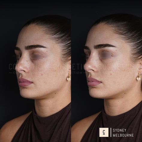 Our non-surgical rhinoplasty is a 15-minute injectable procedure that immediately improves the appearance of your nose. It’s a highly effective solution that can: - Hide bumps and humps - Lift and refine your nose tip - Slim and define your nose bridge - Balance the shape and size of your nose - Straighten a crooked nose - Improve poor surgical rhinoplasty results ⁠ Did you love this result? Want to know if it's right for you? Comment 'NOSE' to claim your complimentary opinion. ⁠⁠⁠ This con... Upper Blephoraplasty, Upper Blephoraplasty Before And After, Bulbous Nose Rhinoplasty, Nose Rhinoplasty, Nose Tip, Bulbous Nose, Crooked Nose, Rhinoplasty Before And After, Nose Bridge