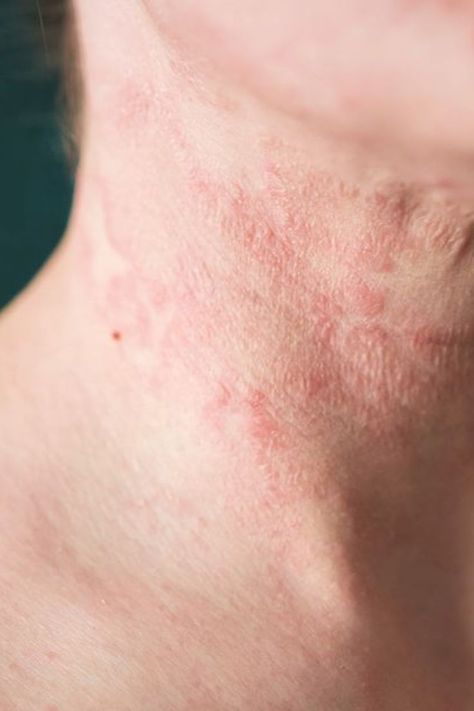 #Wellness #Home #Solutions #for #HealthyLiving #Workout #Common #Remedies #Natural #HealthTips #Ailments Rash On Face, Rash On Neck, Remove Skin Tags Naturally, Itchy Rash, Body Hair Removal, Unwanted Hair Removal, Homemade Face, Unwanted Hair, Natural Home Remedies