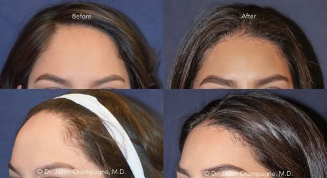 Hairline Surgery, Hairline Reduction Surgery, Forehead Surgery, Forehead Reduction Before And After, Hairline Lowering Surgery, Forehead Reduction Surgery, Hair Big Forehead, Forehead Reduction, Hairline Transplant