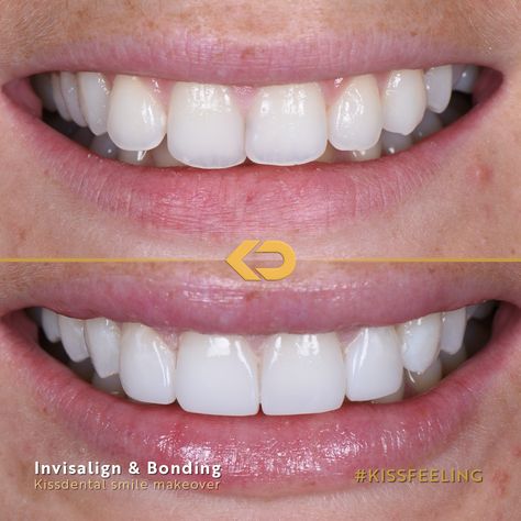 Edge Bonding Teeth, Edge Bonding Teeth Before And After, Composite Edge Bonding Teeth, Composite Bonding Teeth, Composite Fillings Tooth, Dental Bridge Before And After, Teeth Makeover, Teeth Correction, Perfect Smile Teeth