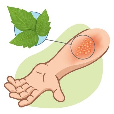 Poison Ivy Remedies, Witch Hazel Uses, Poison Oak, Natural Healing Remedies, Essential Oil Benefits, Cold Home Remedies, Natural Therapy, Oil Benefits, Witch Hazel