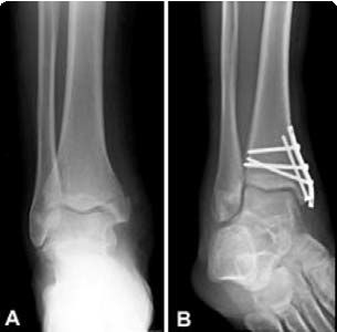 Barbie Hospital, Broken Ankle Recovery, Avulsion Fracture, Removable Braces, Medical Printables, Miniature Medical, Ankle Ligaments, Ankle Fracture, Mini Diorama