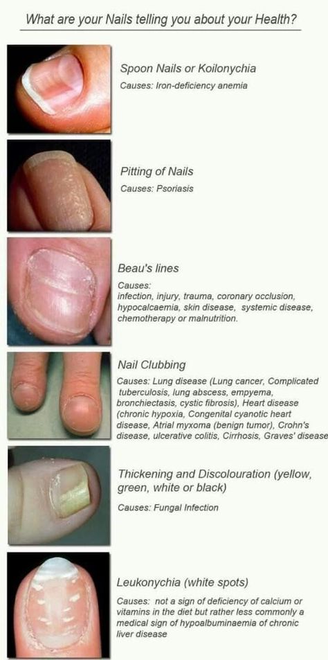 how to keep nails healthy Nail Health Signs, Med Aesthetic, Nail Anatomy, Forensic Medicine, Dermatology Nurse, Nail Disorders, Health Chart, Nail Problems, Health Signs