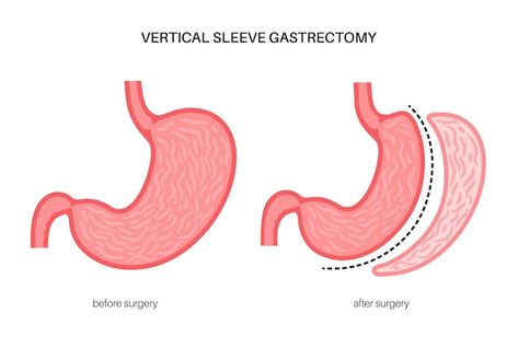 Vertical sleeve gastrectomy laparoscopy ... | Premium Vector #Freepik #vector #gastric-sleeve #gut #digestive-system #stomach Vertical Sleeve Gastrectomy, Sleeve Gastrectomy, Sleeve Surgery, After Surgery, Digestive System, Side Effects, Premium Vector, Surgery