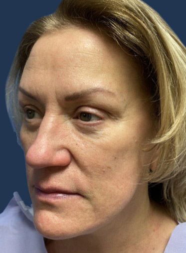 Case-48262 - New York Plastic Surgical Group Bulbous Nose Rhinoplasty Before After, Revision Rhinoplasty, Bulbous Nose, Rhinoplasty Before And After, Post Op, Plastic Surgeon, Surgery, A Woman, New York