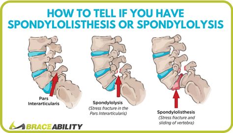 How to Tell If You Have Lumbar Spondylolisthesis or Spondylolysis in Your Lower Back Back Problems Lower, Pars Defect, Spinal Chord, Anatomy Spine, Spine Problems, Chronic Back Pain, Middle Back Pain, Back Pain Remedies, Spine Health