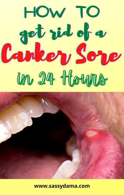 How To Get Rid Of Cold Sores, Sore On Tongue Remedy, Mouth Sore Remedy How To Get Rid, Mouth Sore Relief, Natural Canker Sore Remedies, Sores In Mouth Remedies, Sores In Mouth, Canker Sore Remedy Overnight, Diy Canker Sore Remedy Fast