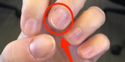 Your nails are more than a thing to polish. They could be signals of serious health problems. Brittle Toenails, Nail Symptoms, Peeling Nails, Nail Conditions, Throbbing Headache, Nail Vitamins, Curved Nails, Weak Nails, Vitamin Deficiency