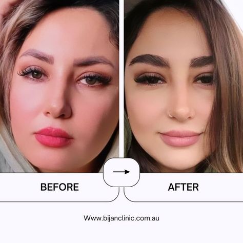 Achieve the perfect brow transformation at Bijan Hair and Eyebrow Transplant Clinic in Australia. Specialized eyebrow transplant for natural and fuller brows. ..... CONTACT INFO ■www.bijanclinic.com.au ■Tel - 0291917491 ■ info@bijanclinic.com.au #EyebrowTransplant #BrowTransformation #HairClinic #sydney #bijanclinic #NaturalBrows #FullerBrows #AustraliaClinic #CosmeticSurgery #EyebrowGoals #EyebrowSpecialist #PermanentBrows #BeautyEnhancement #BrowGameStrong #بیوتی #زرع_الحواجب #عناية_بال... Good Eyebrows, Brow Transformation, Drawing Natural, Eyebrow Transplant, Girl Hacks, Eyebrow Trends, Perfect Brow, Eyebrow Hacks, Full Brows