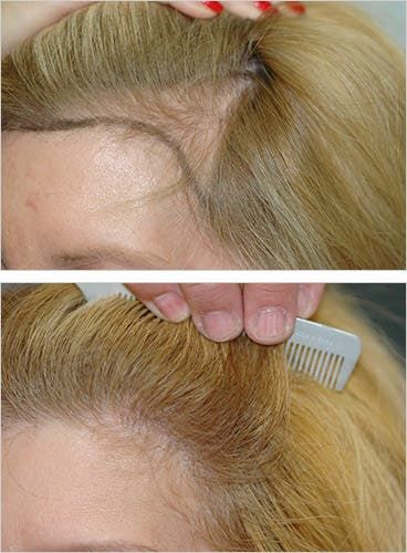 Hair Transplant Women, Hair Plugs, Dramatic Hair, Hair Line, Hair Regrowth, Hair Restoration, Hair Transplant, Women's Hair, Bad Hair