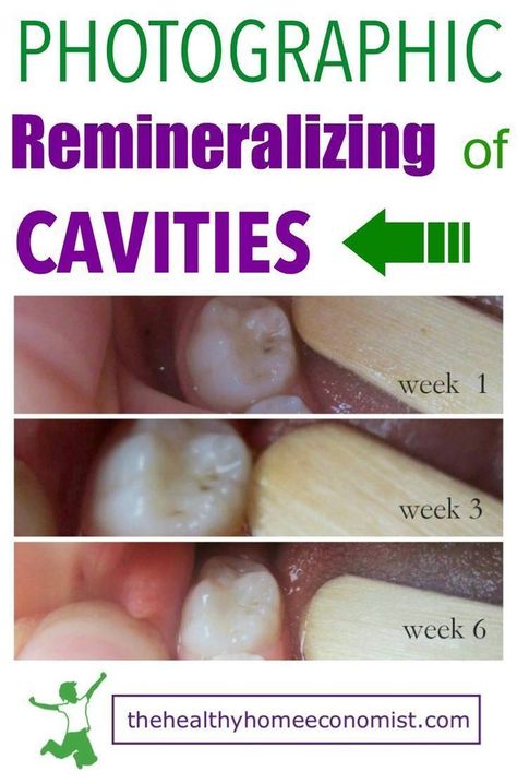 Do you have cavities but aren't able to go to the dentist? If so, you will want to see these photos from The Healthy Home Economist proving that you can fix it yourself! Read all about these hacks on how to heal your teeth from cavities. Cavity Remedy, Remineralize Teeth, Tooth Decay Remedies, Heal Cavities, Teeth Health, How To Prevent Cavities, Oral Care Routine, Gum Health, The Dentist